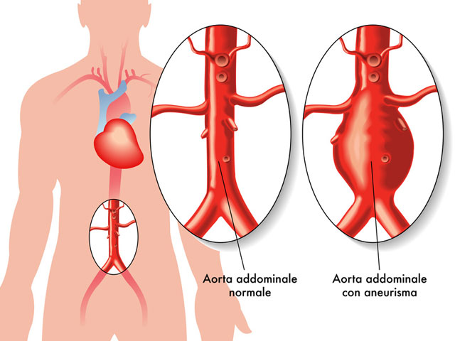 Aneurisma dell'aorta, è possibile prevenire la rottura? Alle 20 'Dica 33'